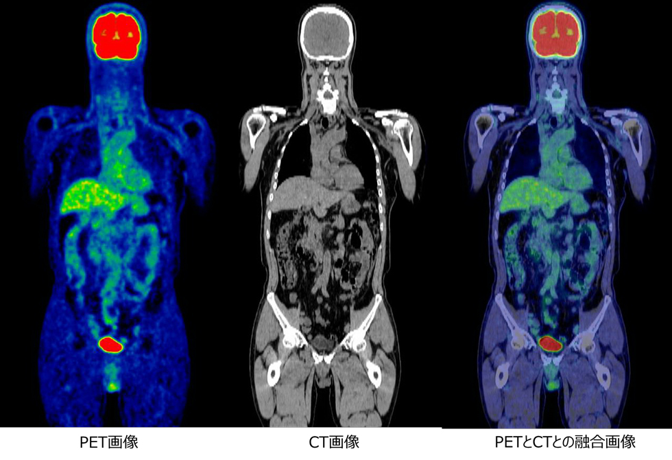 PET-CTフルコース人間ドック